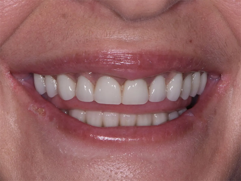 after-crown-treatment