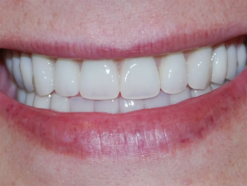 after-dentures-treatment