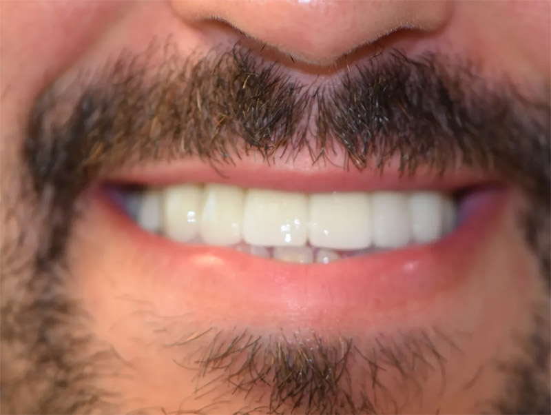 after-full-mouth-rehab-treatment