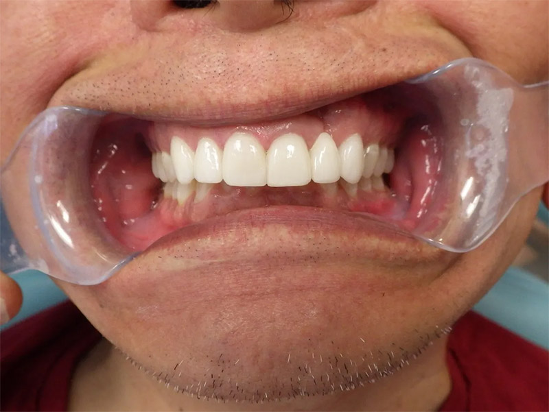 after-venners-treatment