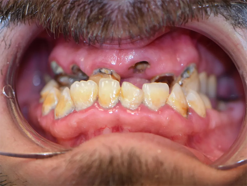 before-full-mouth-rehab-treatment