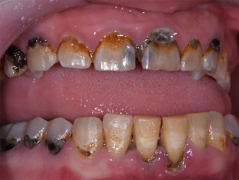 before-veneers-treatment